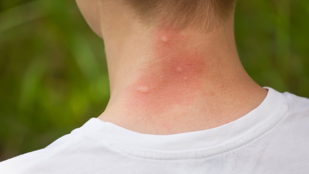 Une piqûre de scolopendre