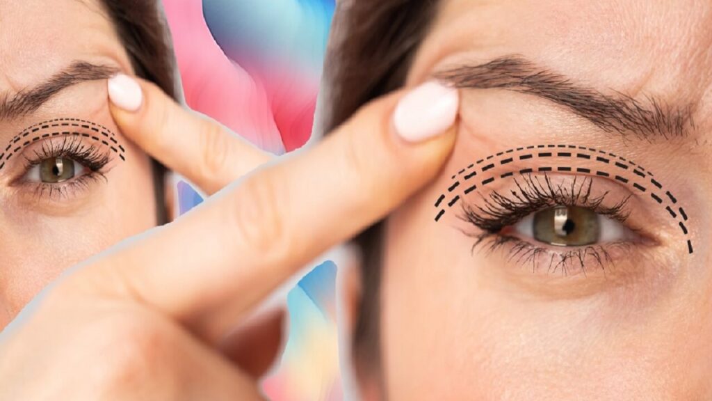 Des paupières tombantes à cause du botox