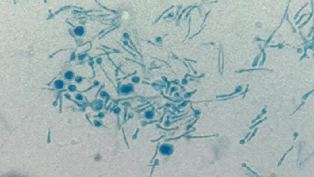 infection champignon homme (1)