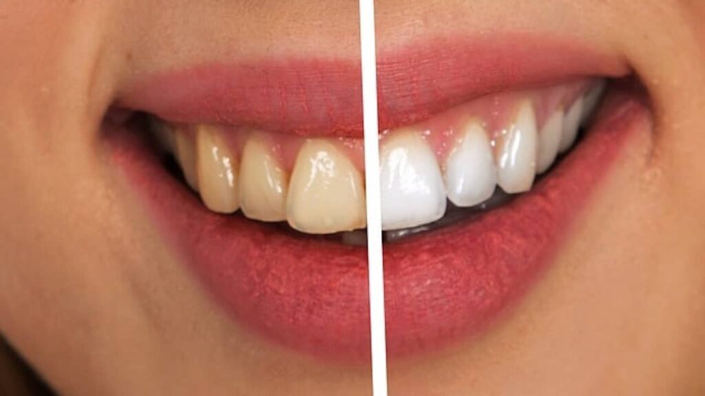 Avoir des dents plus blanches