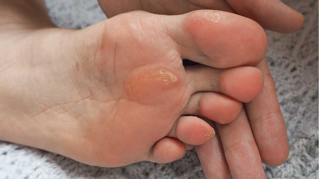 pieds malmenés