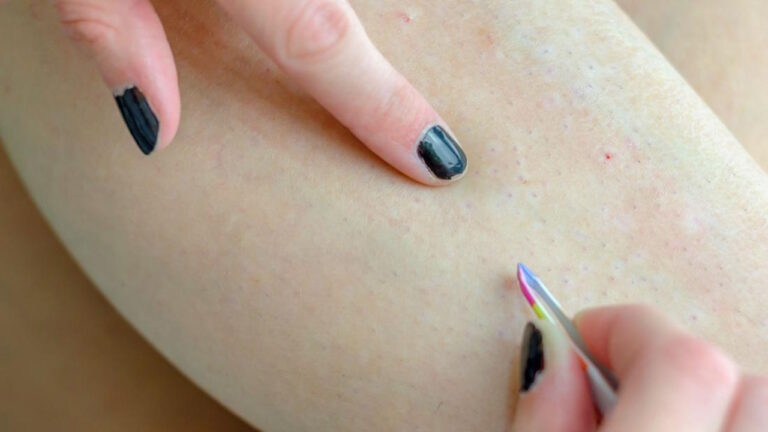 Les poils incarnés : comprendre les causes et les meilleures façons de