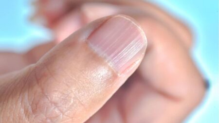 Les ongles striés