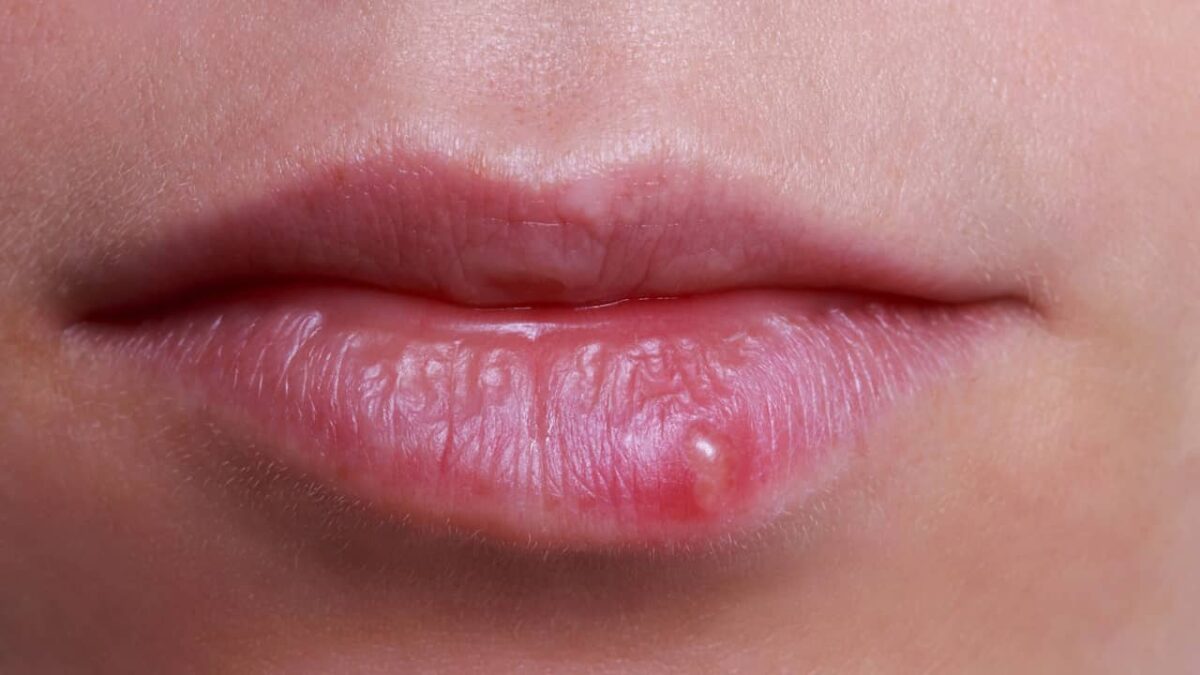 Bouton de fièvre causes, symptômes et traitements — free download