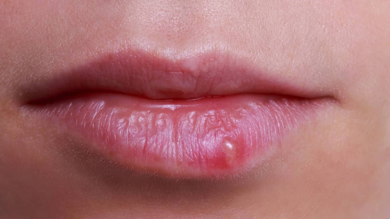 Bouton de fièvre : causes, symptômes et traitements