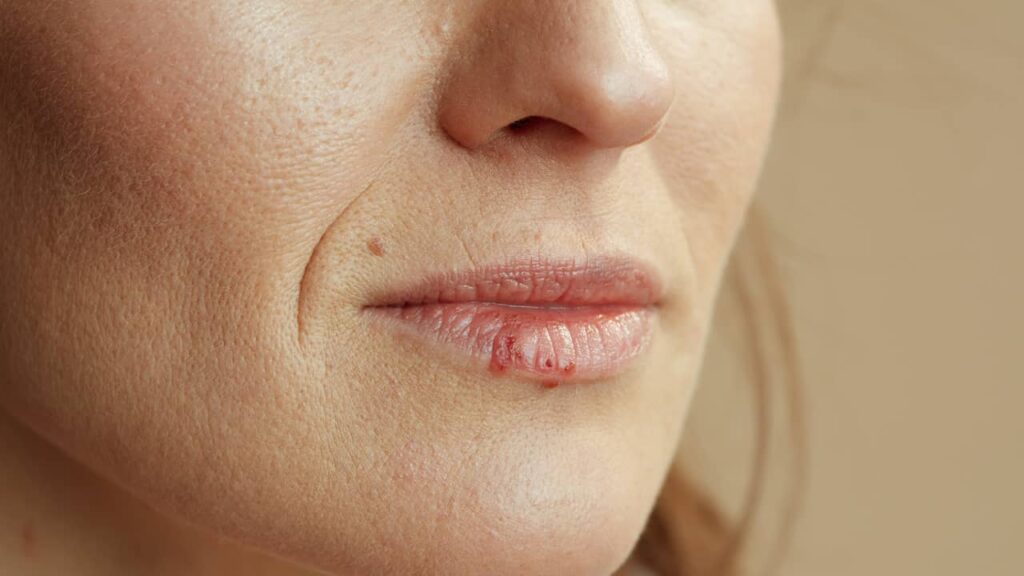 herpes bouton fivre lèvres bouche