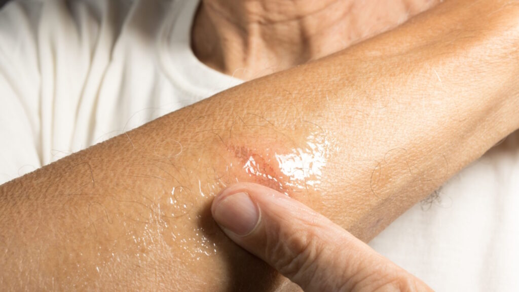 La cicatrisation et les soins des brûlures