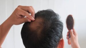 causes et solutions à la perte de cheveux