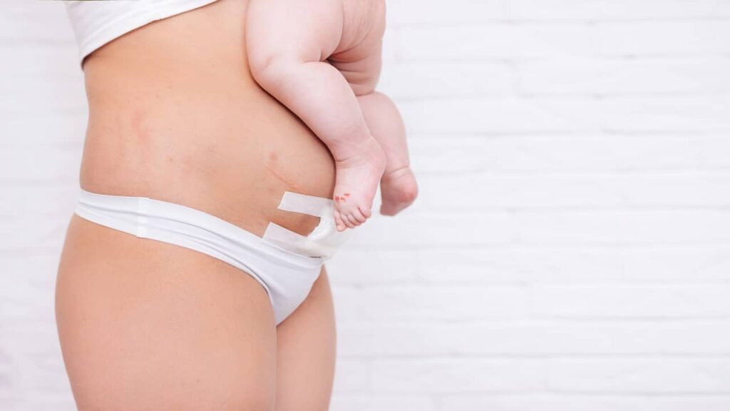 casarienne pansement maman porte bébé