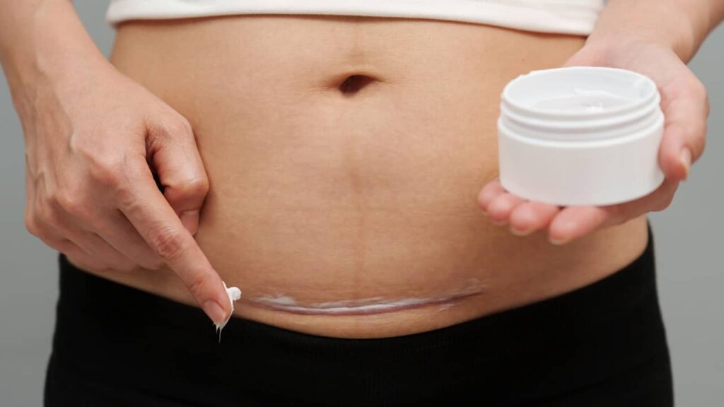 cicatrice cesarienne creme