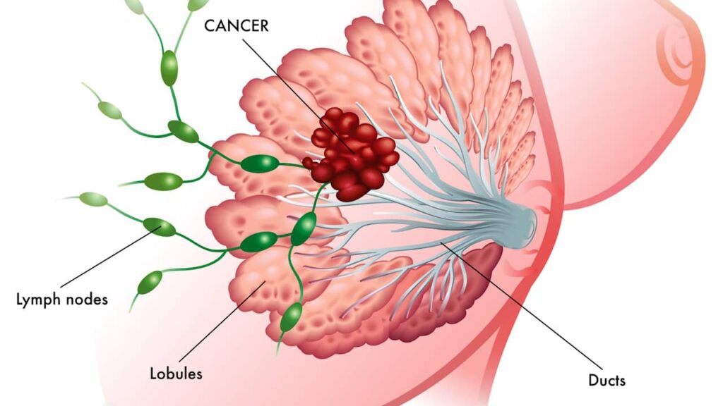 image cancer sein