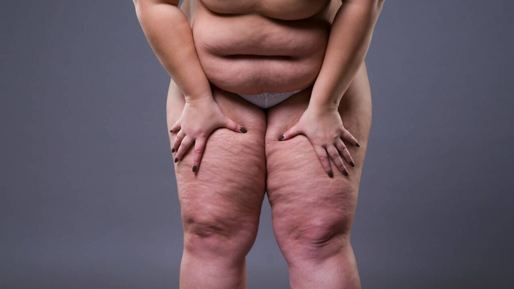 lipoedeme cellulite maladie jambes