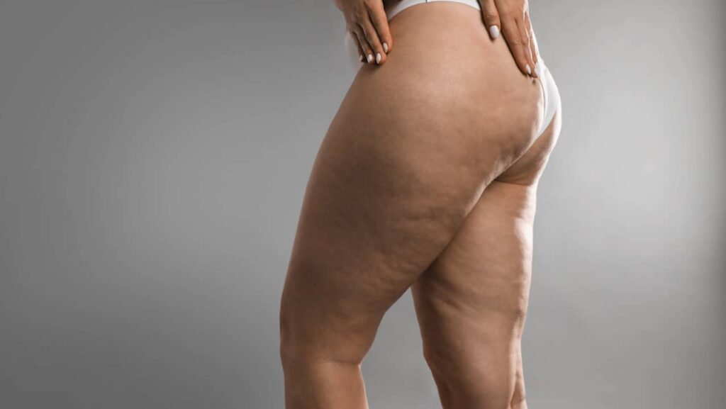 lipoedeme maladir jambes