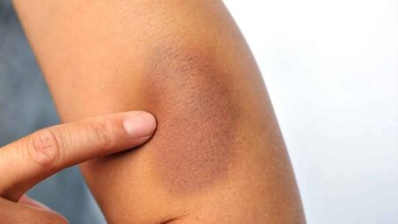 Bleus sans raison apparente : quand faut-il s’inquiéter ? Bleus sans raison apparente