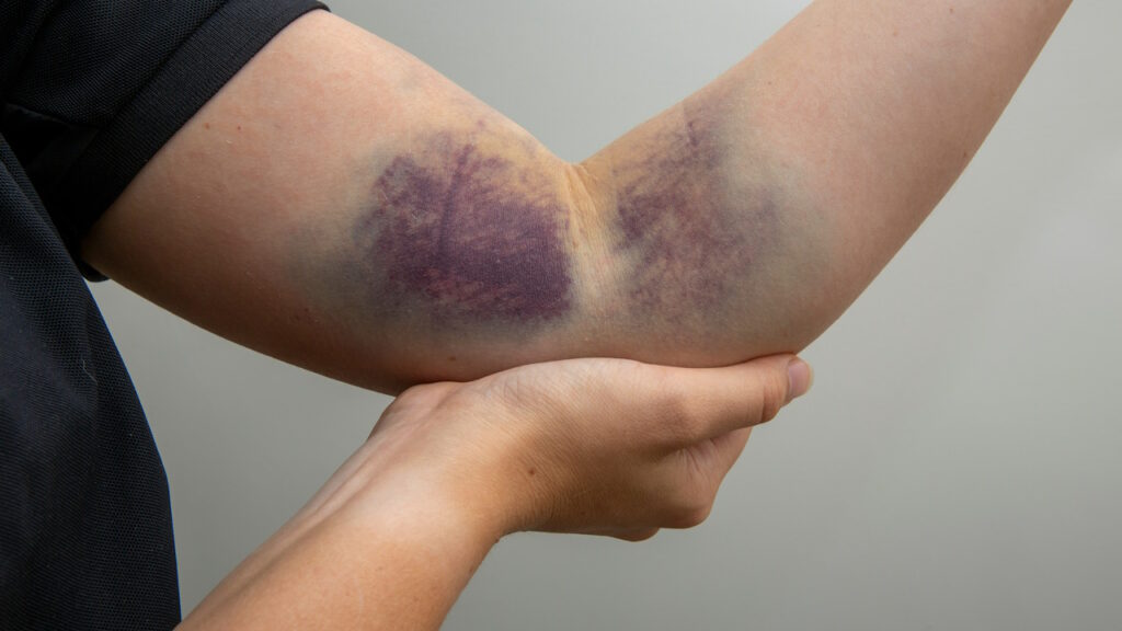 Les troubles de la coagulation