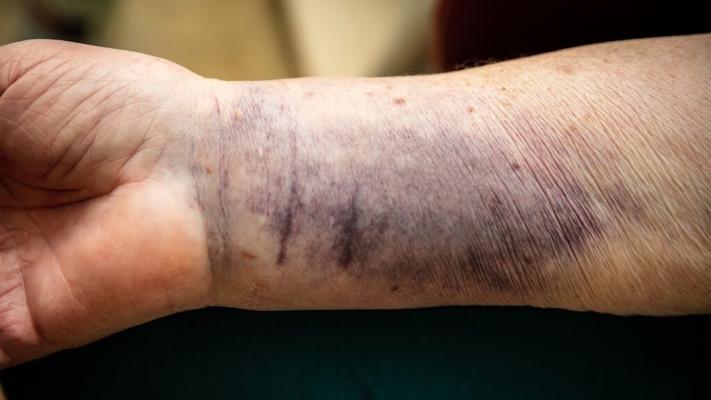 Une peau plus fragile avec l’âge