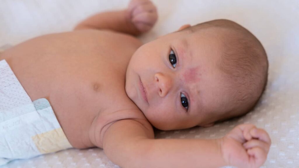 bebe tache naissance visage