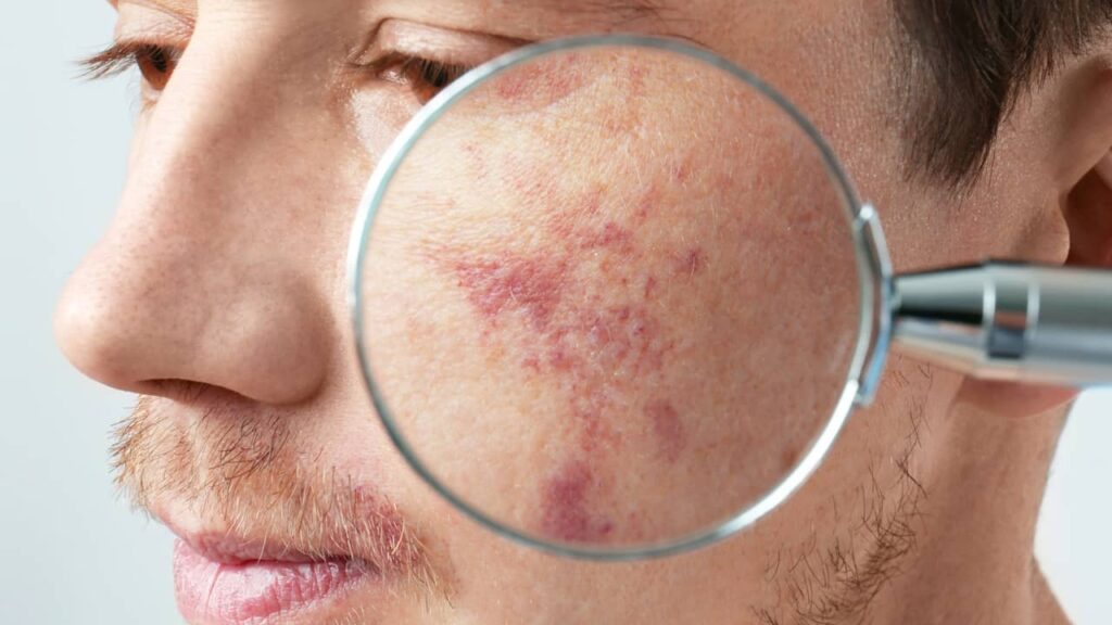 homme tache naissance zoom visage