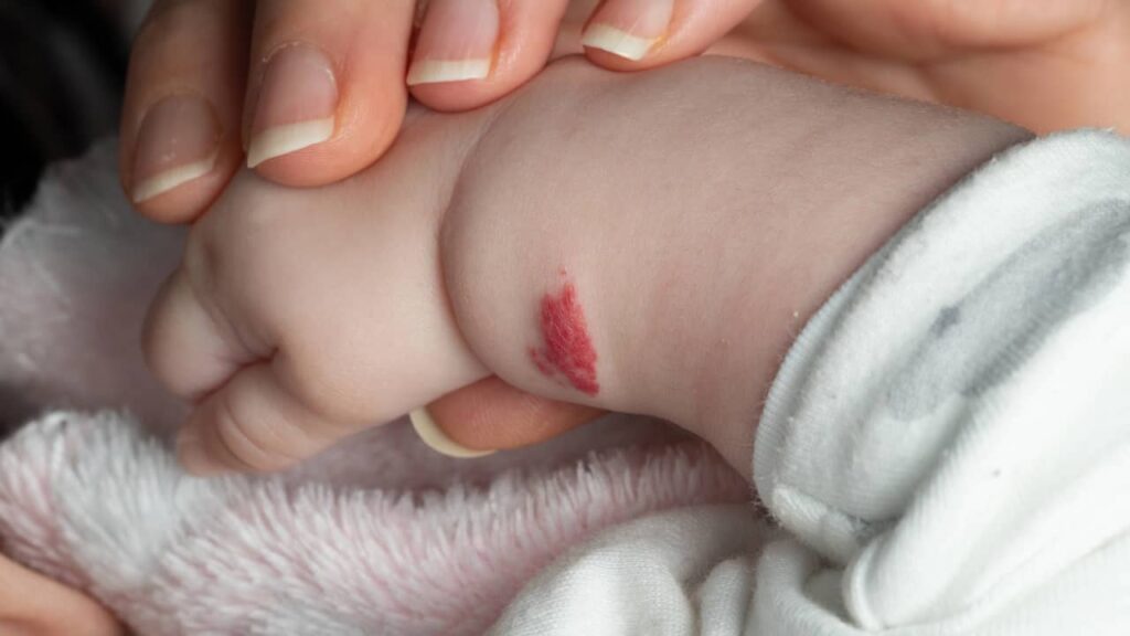 tache naissance bras bébé