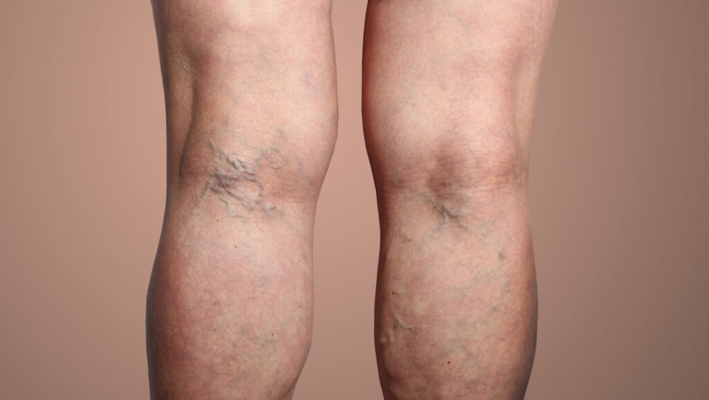 Les varices et l’insuffisance veineuse
