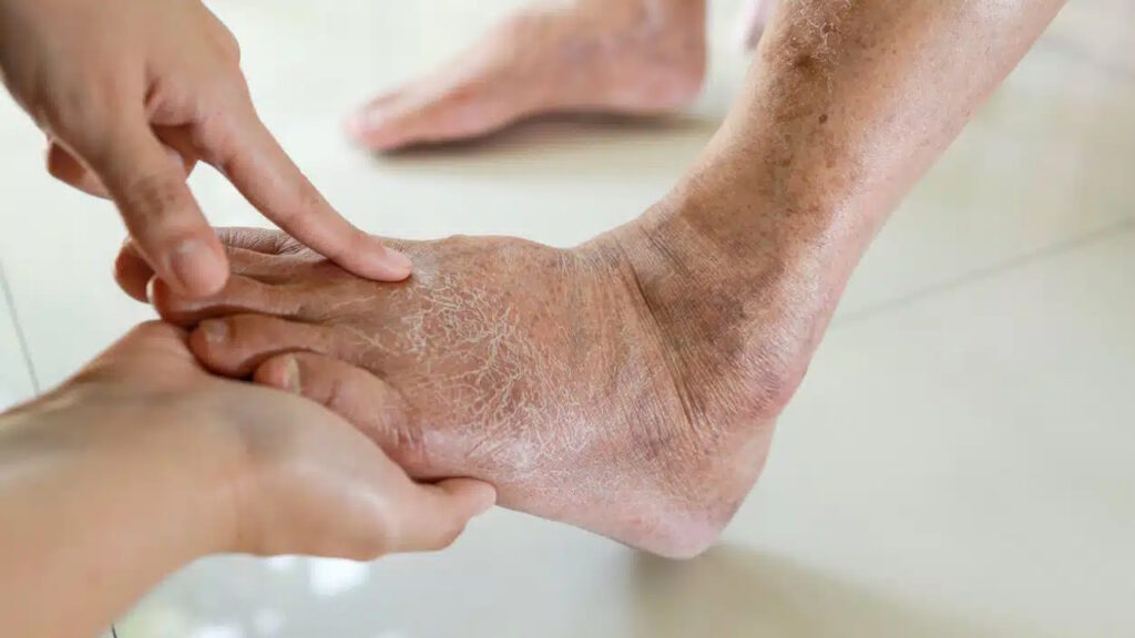 Une mauvaise circulation sanguine
