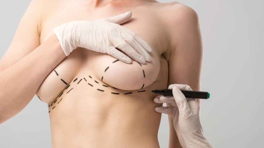 chirurgie esthetique sein